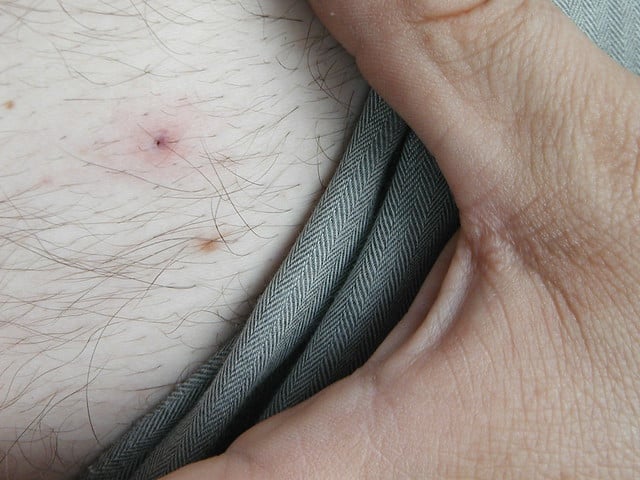 Tick head stuck in skin