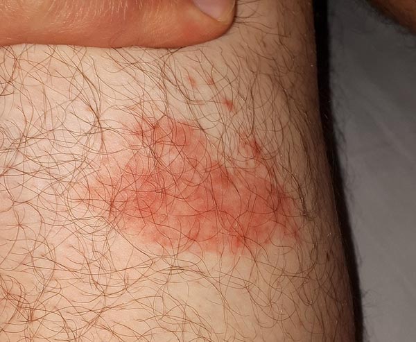 Early stage lyme rash