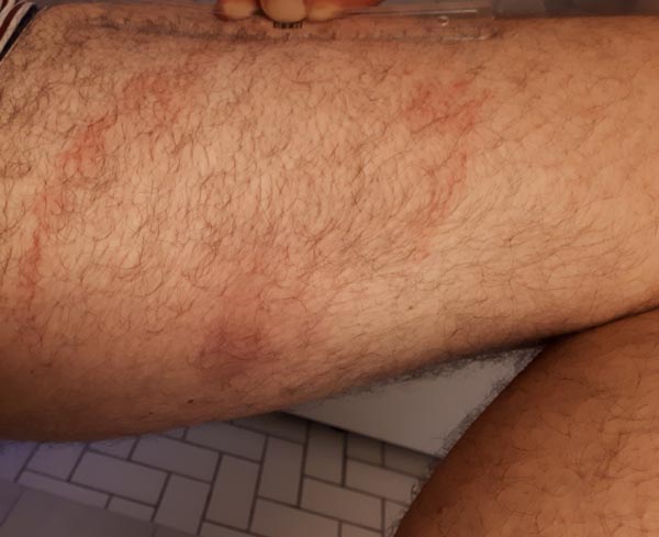 untreated Lyme rash at 8 weeks