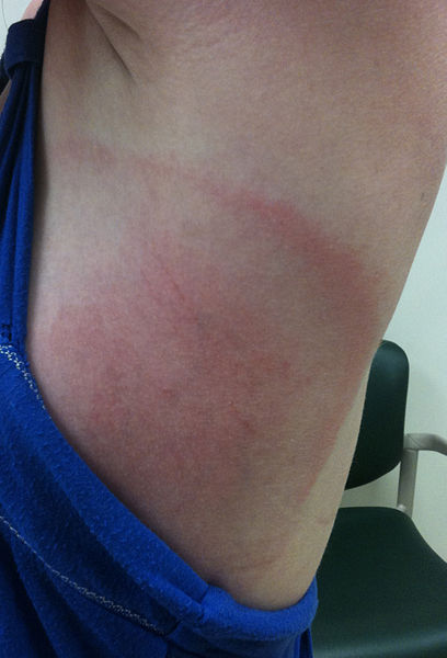 bulls eye shaped lyme rash