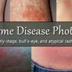 Lyme disease photos