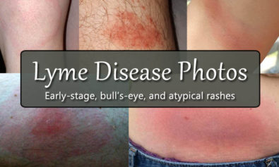 Lyme disease photos