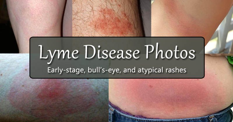 Lyme disease photos