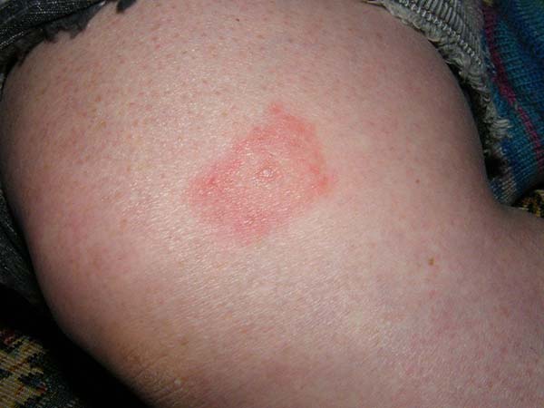 lyme disease rash photo with red bump in middle