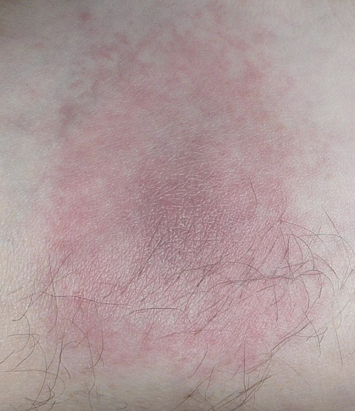 Lyme rash two weeks after being bit