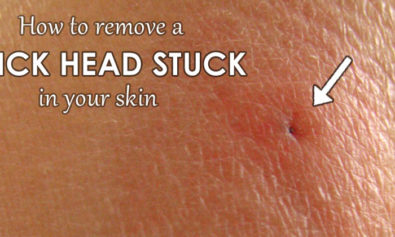 remove tick head stuck in skin