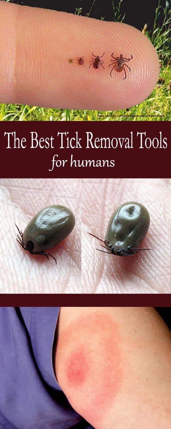 best tick removal tools for humans